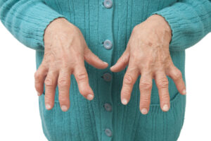 artrita reumatoidă cum să piardă în greutate modalități neobișnuite de a pierde grăsimea de burtă