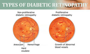 Retinopatia diabetica - informatii complete