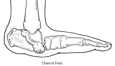Piciorul Charcot in diabet