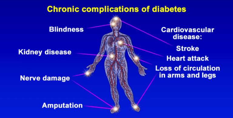 Diabetul si complicatiile sale