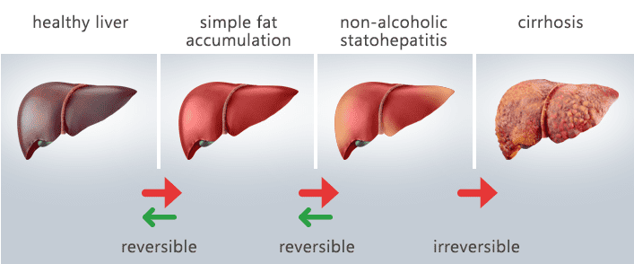 Ficatul gras (steatoza hepatica)
