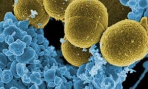 Diabetul indus de infectii
