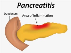 Diabetul prin afectarea pancreasului exocrin