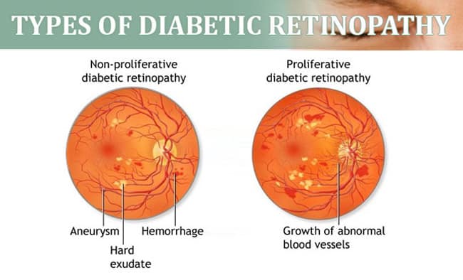 Etiopatogenia retinopatiei diabetice