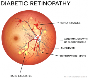Etiopatogenia retinopatiei diabetice