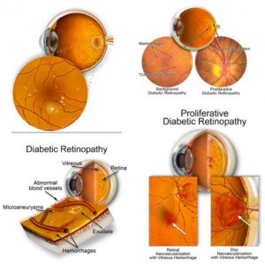 Retinopatia diabetica neproliferativa si proliferativa