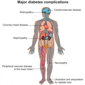 Efectele diabetului