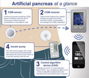 Pancreasul artificial
