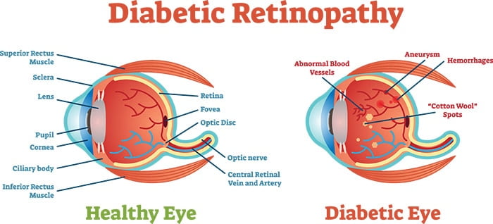 Retinopatia diabetica – clasificare
