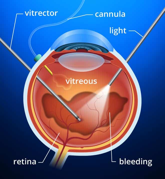 Vitrectomia